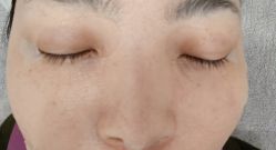 体验前-叶美人医疗美容