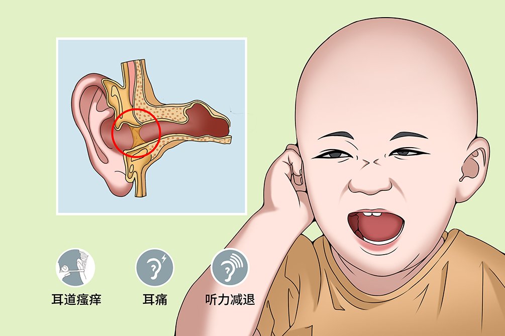 耵聍栓塞是什么意思图片