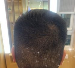-大麦微针植发丨全国连锁