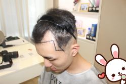 点击看大图 -大麦微针植发丨全国连锁