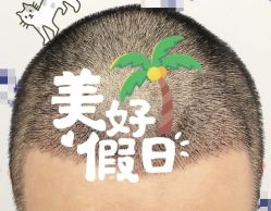 -大麦微针植发全国连锁