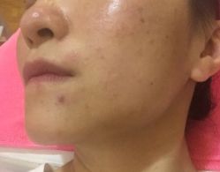 -成都苗方清颜专业祛痘