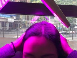 -碧莲盛·不剃发植发