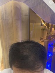 -碧莲盛·不剃发植发