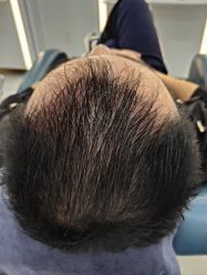 体验后-大麦微针植发全国连锁