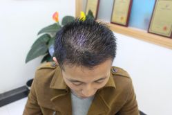 -大麦微针植发丨全国连锁