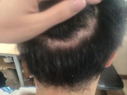 -碧莲盛·不剃发植发