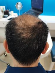 -大麦微针植发丨全国连锁