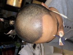 -大麦微针植发丨全国连锁