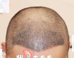 -大麦微针植发全国连锁