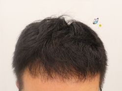 -大麦微针植发全国连锁