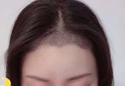 -大麦微针植发丨全国连锁