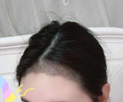 -大麦微针植发丨全国连锁