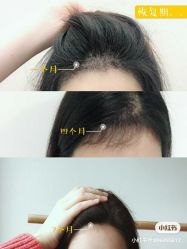 -大麦微针植发全国连锁