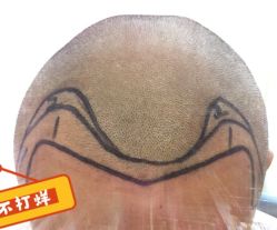 -大麦微针植发全国连锁