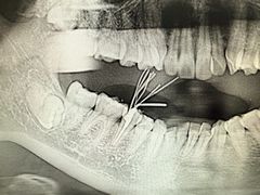-上海仁爱医院口腔科 · 种植