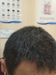 -碧莲盛·不剃发植发