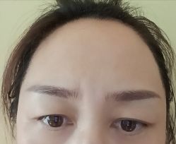 体验后-北京英煌医疗美容