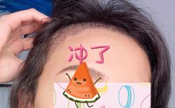 -大麦微针植发全国连锁