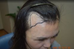 体验前-大麦微针植发全国连锁