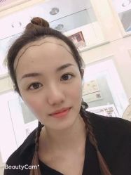 -大麦微针植发丨全国连锁