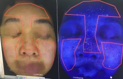 -安那般那皮肤年轻化ANAPANA