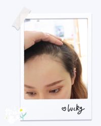 体验后-大麦微针植发全国连锁