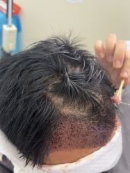 -大麦微针植发全国连锁