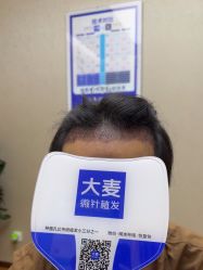 -大麦微针植发全国连锁