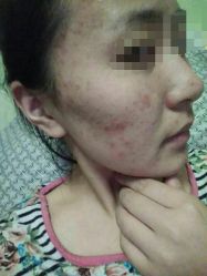 -荟草堂痘肌修护中心