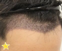 -大麦微针植发丨全国连锁