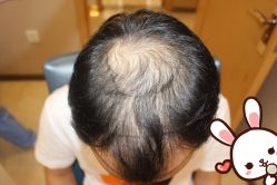 -大麦微针植发丨全国连锁