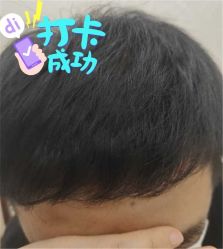 -大麦微针植发全国连锁