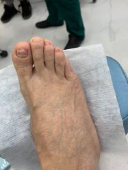 -派恩宜灰指甲鸡眼嵌甲手足癣