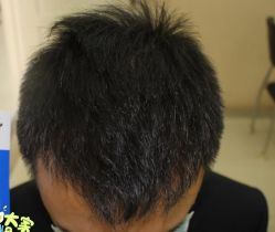 -大麦微针植发丨全国连锁