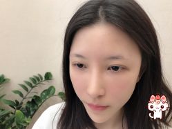 -大麦微针植发丨全国连锁