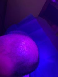 -碧莲盛·不剃发植发