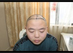 -大麦微针植发全国连锁