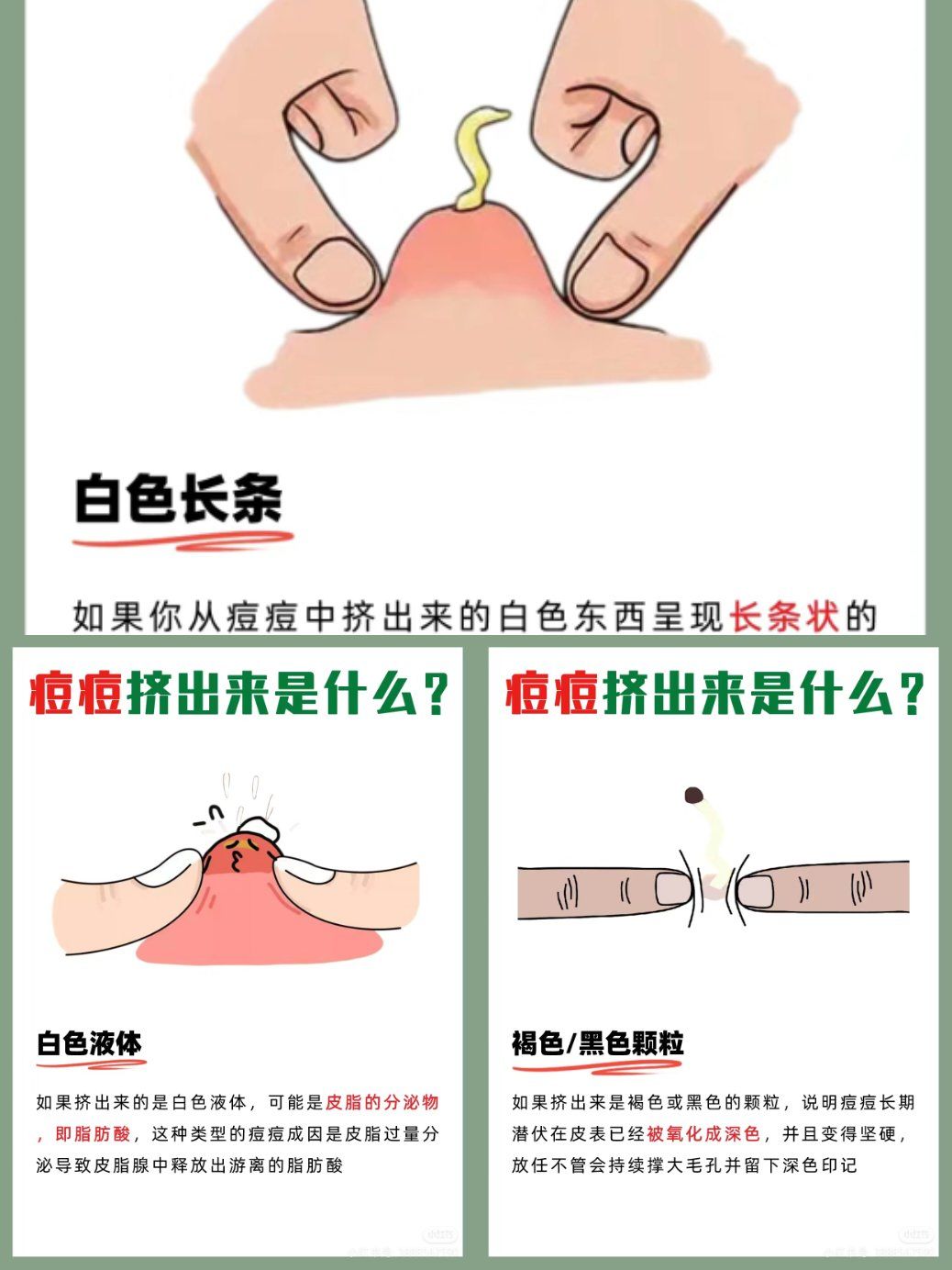 痘痘挤出来的是什么