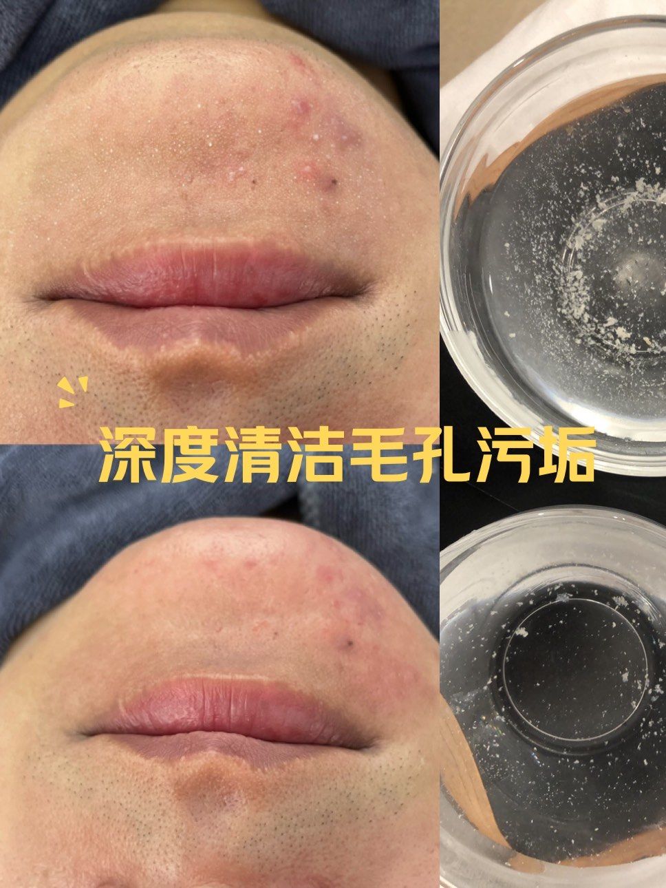 深度清洁|还你嫩滑肌肤