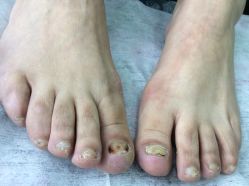 -德哥灰指甲脚气甲沟炎跖疣护理