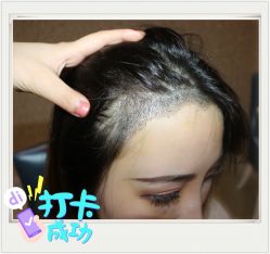 点击看大图 -大麦微针植发全国连锁