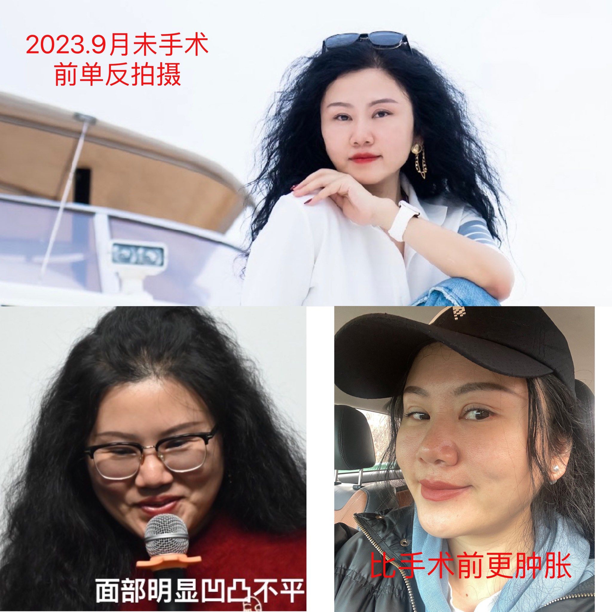 账号里的照片对比
2023年10月28号,朋友推荐到韩国必妩做双眼皮修复