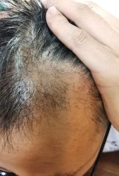 点击看大图 体验后-熙朵美学植发连锁