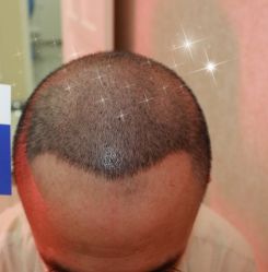 -大麦微针植发丨全国连锁