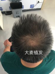 点击看大图 体验后-大麦微针植发全国连锁