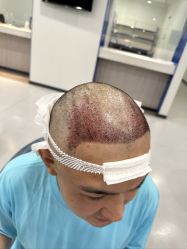 -大麦微针植发全国连锁