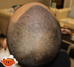 -大麦微针植发丨全国连锁