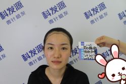 点击看大图 -大麦微针植发丨全国连锁