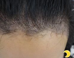 -大麦微针植发丨全国连锁